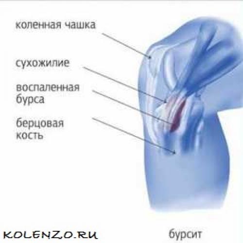 Коленная чашечка. Почему болит коленная чашечка: причины, симптомы, лечение
