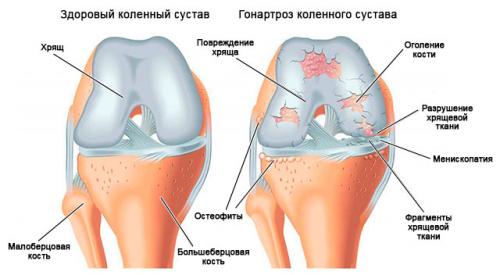 Горячие колени и ноют. Самые частые причины ноющей боли в коленях, что делать, лечение