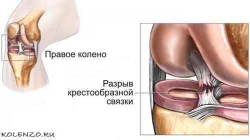 Коленный сустав связки. Крестообразная связка коленного сустава: анатомия, травмы, лечение