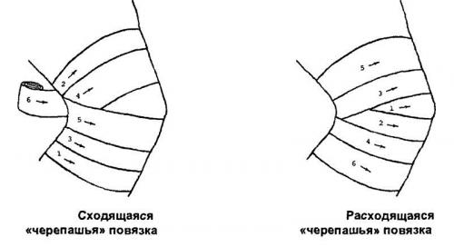 Черепашья сходящаяся и расходящаяся повязка на локтевой сустав. Виды и показания к применению