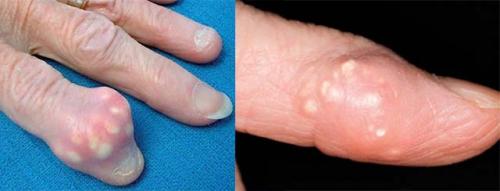 Опухли суставы пальцев рук лечение. Основные причины и методы лечения опухших суставов пальцев на руке