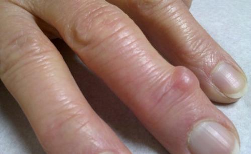 Шишка на внутреннем сгибе пальца. Какие виды встречаются