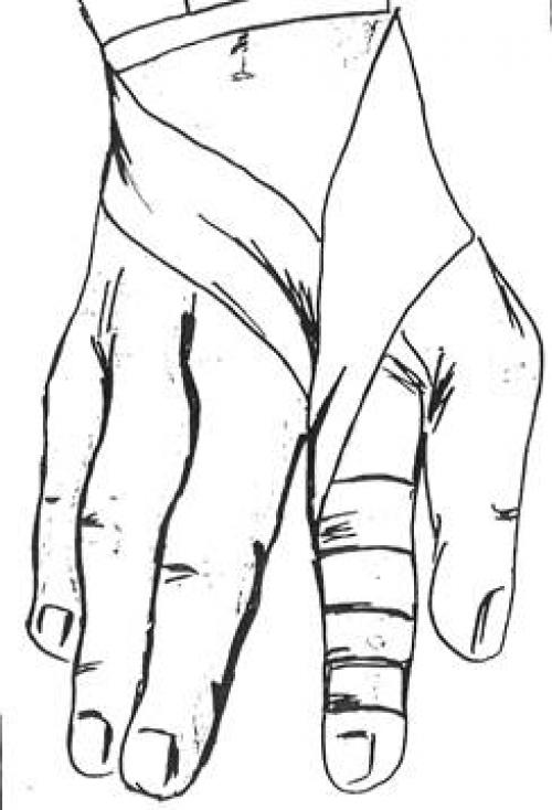 Повязка варежка. Алгоритм наложения повязки «варежка» на все пальцы кисти.