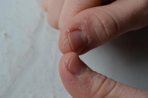 На руке на пальце трескается кожа. Трескается кожа на пальцах рук причины и лечение