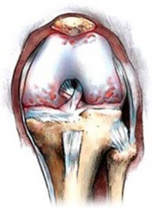 Восстановление хрящевой ткани коленного сустава. Как восстановить хрящевую ткань сустава?