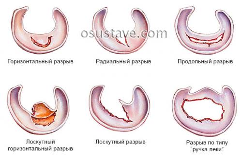 Дегенеративные изменения заднего рога медиального мениска 2 ст по stoller. Дегенеративные изменения менисков: заднего рога, медиального, 4 степени патологии