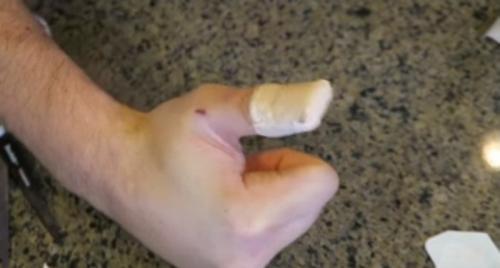 Как клеить пластырь. Как приклеить лейкопластырь на палец, чтобы он не сползал: простой способ, о котором самому не догадаться 05