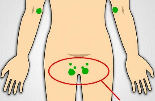 Увеличены лимфоузлы и болят. Причины увеличения лимфатических узлов под челюстью 03
