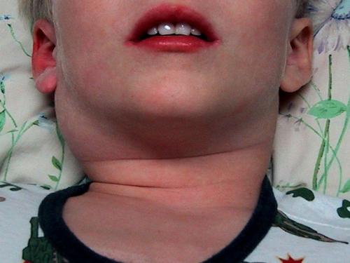 Увеличены лимфоузлы на шее у ребенка. Что делать, если у ребенка на шее увеличены лимфоузлы
