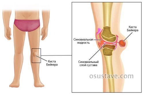 Рассасывается ли киста Бейкера. Обзор кисты Бейкера коленного сустава: причины, симптомы и лечение