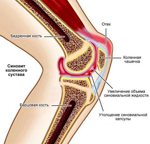Рассасывается ли киста Бейкера. Обзор кисты Бейкера коленного сустава: причины, симптомы и лечение