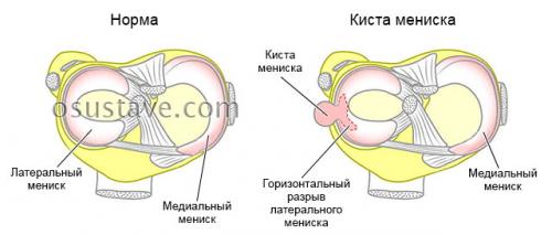 Киста мениска фото