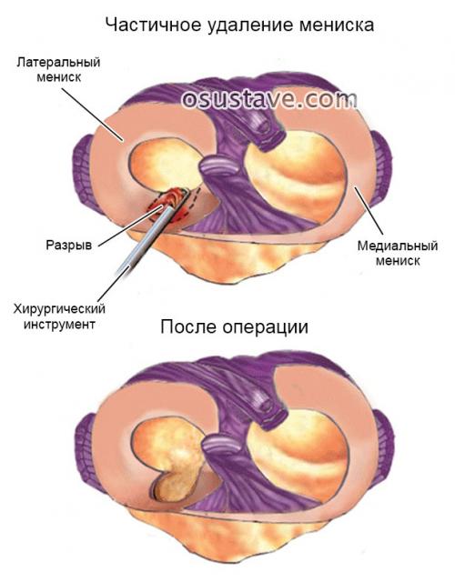 Стоит ли делать операцию на мениск. Техника полного и частичного удаления мениска, эффективность операции, осложнения