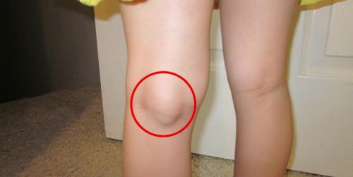 Рассасывается ли киста Бейкера. Обзор кисты Бейкера коленного сустава: причины, симптомы и лечение