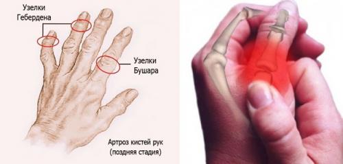 Как лечить артроз кисти рук. Артроз суставов кисти руки лечение