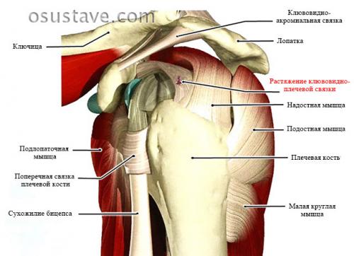 Как долго заживают связки плечевого сустава. Причины растяжения связок плечевого сустава, симптомы, как лечить