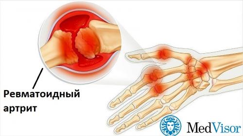 Сахар и суставы. Как диабет влияет на суставы?