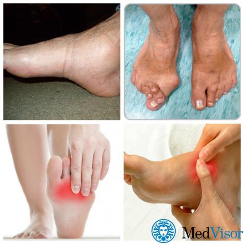 Сахар и суставы. Как диабет влияет на суставы?