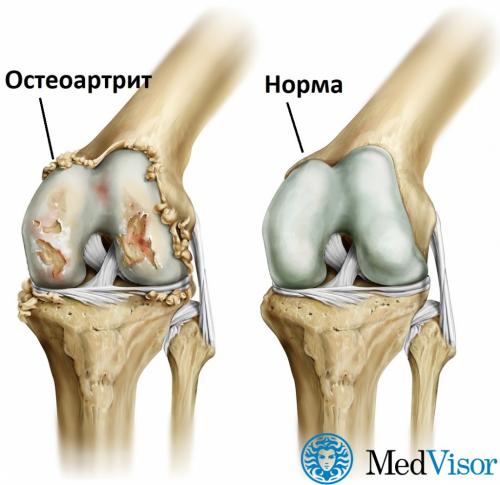 Сахар и суставы. Как диабет влияет на суставы?