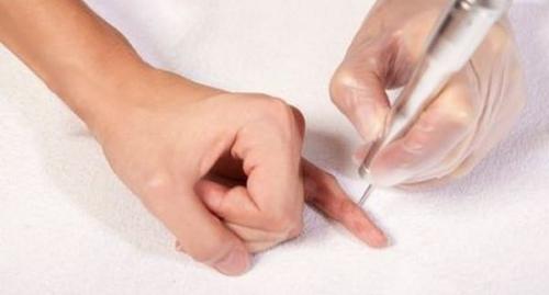 Шишки на фалангах пальцев рук, что делать. Симптомы