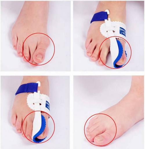 Как вылечить шишки на ногах у большого пальца. Консервативные способы лечения