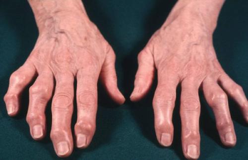 Шишки на фалангах пальцев рук, что делать. Симптомы