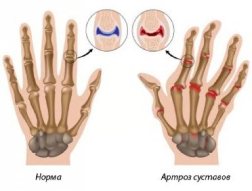 Утолщение суставов на пальцах рук