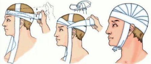 Повязка чепец. Как наложить повязку при травме головы