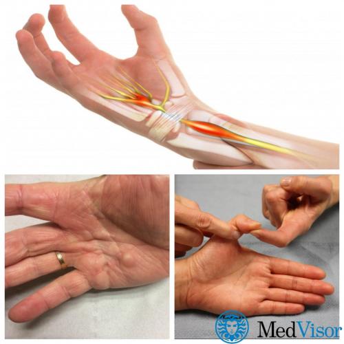 Сахар и суставы. Как диабет влияет на суставы?