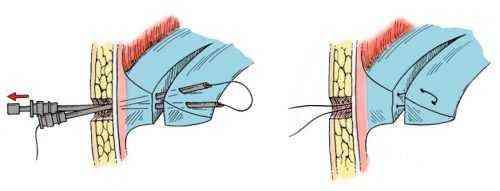Как разрабатывать колено после операции на мениск. Восстановление мениска хирургическим путем