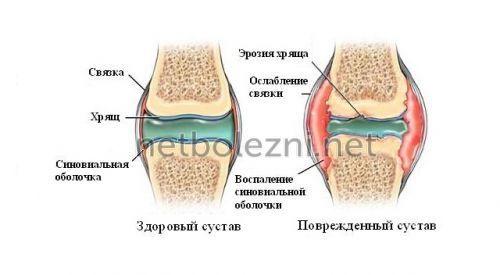 Для суставов и связок народные средства. Упражнения 06 Для суставов и связок народные средства. Упражнения 06