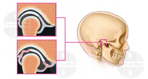Как лечить височно-челюстной артрит. Челюстной артрит