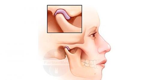 Как лечить височно-челюстной артрит. Челюстной артрит
