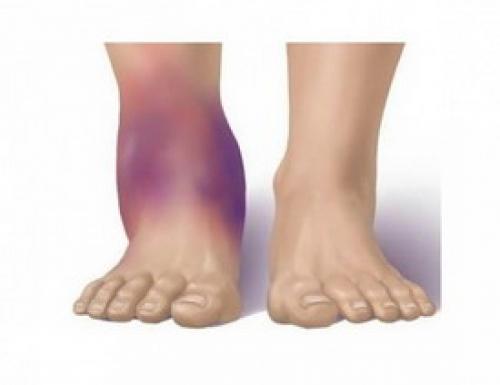 Синовит коленных суставов. Что Такое Синовит И Почему Он Может Возникнуть 10 Синовит коленных суставов. Что Такое Синовит И Почему Он Может Возникнуть 10