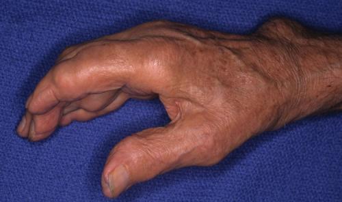 Шишка на пальце руки под кожей. Какие виды встречаются