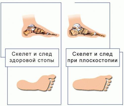Растяжение и перенапряжение связок голеностопного сустава. Растяжение связок голеностопного сустава: лечение, причины, симптомы, полное описание травмы
