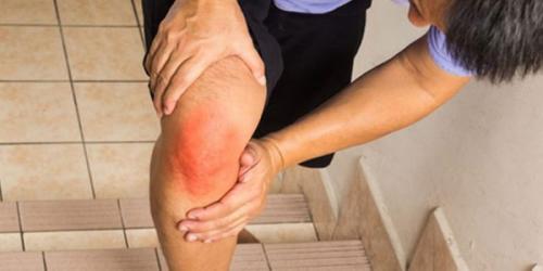 Синовит коленных суставов. Что Такое Синовит И Почему Он Может Возникнуть 05 Синовит коленных суставов. Что Такое Синовит И Почему Он Может Возникнуть 05