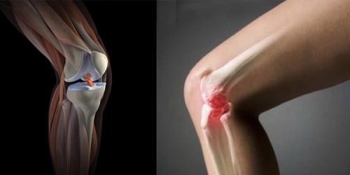 Синовит коленных суставов. Что Такое Синовит И Почему Он Может Возникнуть 02 Синовит коленных суставов. Что Такое Синовит И Почему Он Может Возникнуть 02