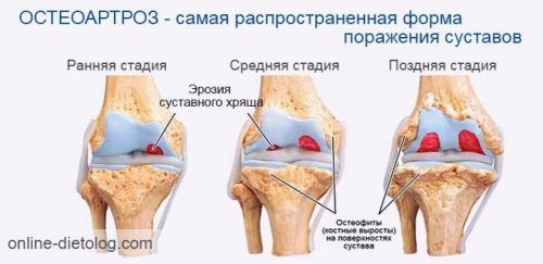 Восстановление хрящей в суставах народными средствами. Восстановление хрящевой ткани коленного сустава: возможно или нет 02 Восстановление хрящей в суставах народными средствами. Восстановление хрящевой ткани коленного сустава: возможно или нет 02