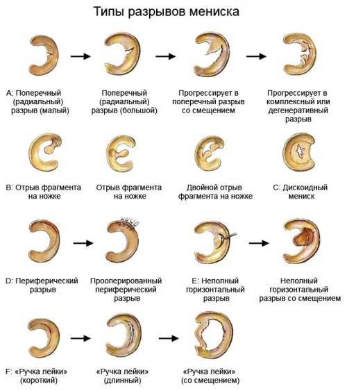 Болит коленка и хрустит при сгибании. Опасные для здоровья причины