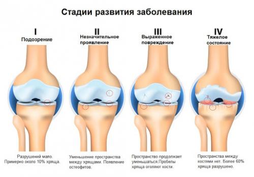 Артроз мкб-10. Причины развития болезни