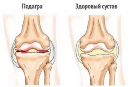Болят пальцы рук после сна. Болят суставы пальцев рук по утрам