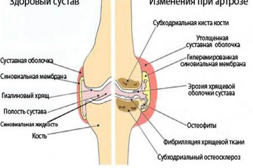 Хрустят и болят пальцы рук. Каковы причины хруста пальцев рук? 18 Хрустят и болят пальцы рук. Каковы причины хруста пальцев рук? 18