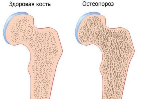 Хрустят и болят колени, что делать. Почему хрустят колени и что с этим делать?