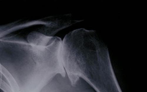 Почему хрустят суставы плечевые. Хруст в плечевом суставе при поднятии руки 06