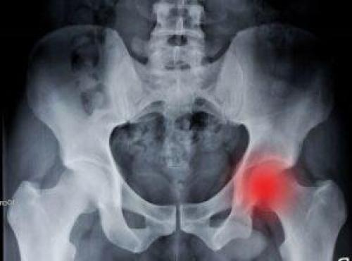 Коксартроз тазобедренного сустава лечение. Как лечить коксартроз на любой стадии