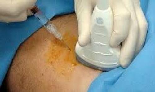 Коксартроз тазобедренного сустава лечение. Как лечить коксартроз на любой стадии