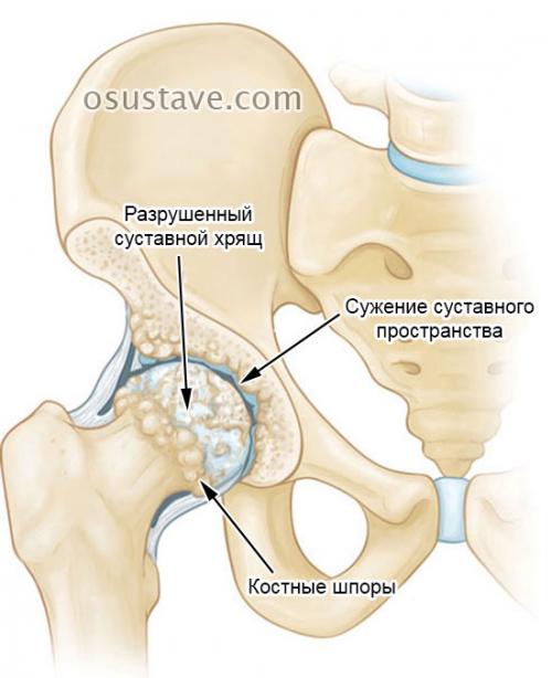 Коксартроз тазобедренного сустава 3 степени. Консервативное лечение или операция