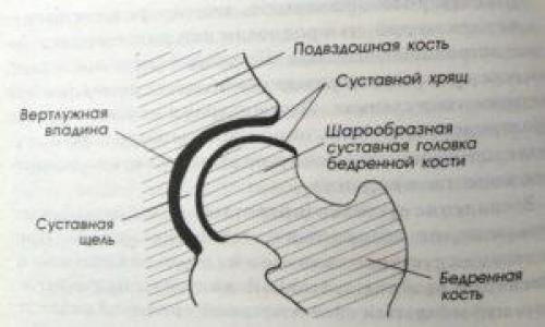 Коксартроз тазобедренного сустава лечение. Как лечить коксартроз на любой стадии