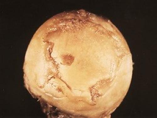 Лечение артроза тазобедренного сустава в домашних условиях. Происхождение болезни